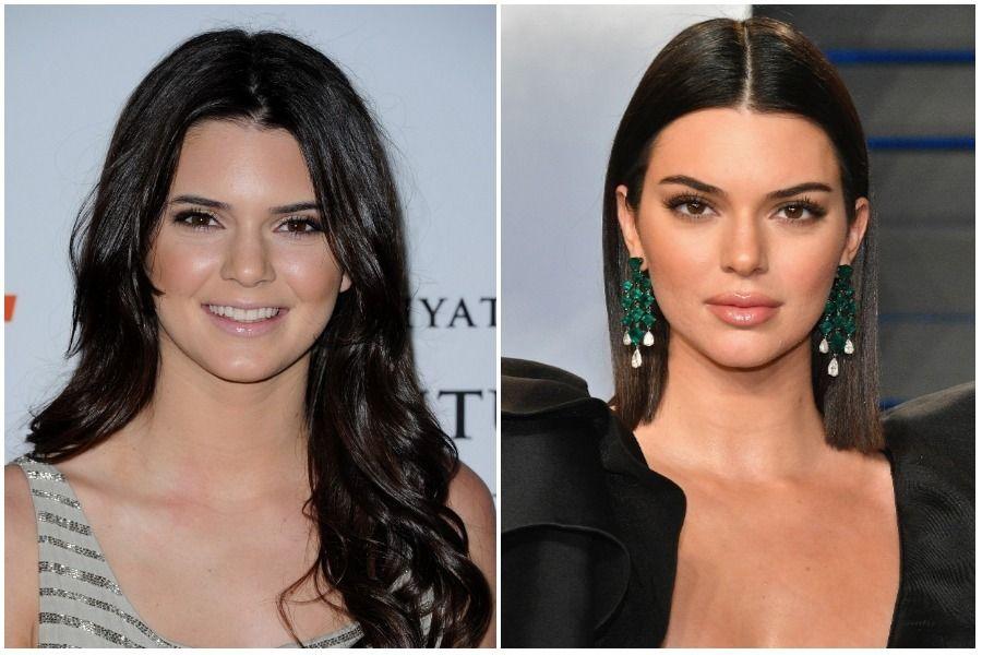 Las cirugías plásticas de Kendall Jenner