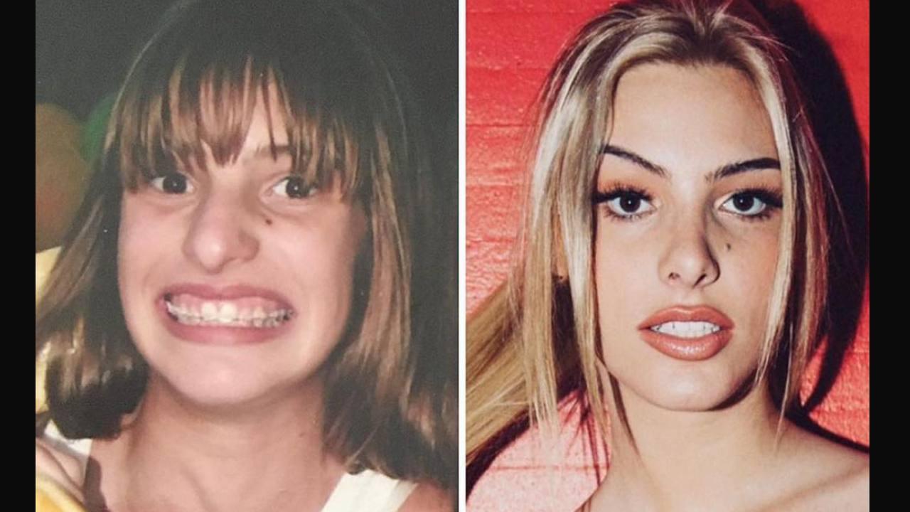 Lele Pons: el antes y después de sus cirugías